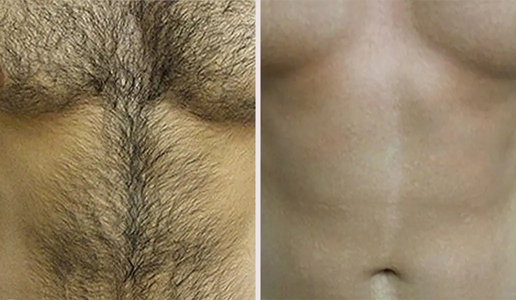 Patient 1 Laser Hair Removal San Antonio Before & After Photos