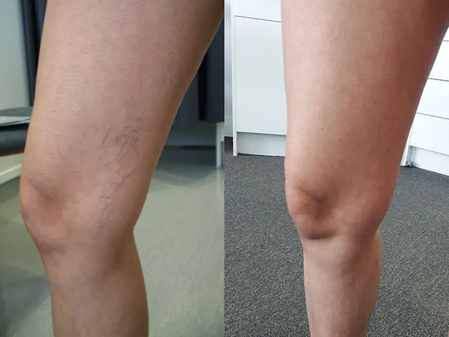 Patient 1 Spider Vein Removal San Antonio Before After Photo