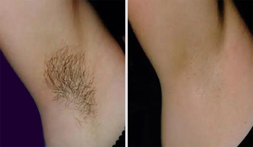Patient 2 Laser Hair Removal San Antonio Before & After Photos