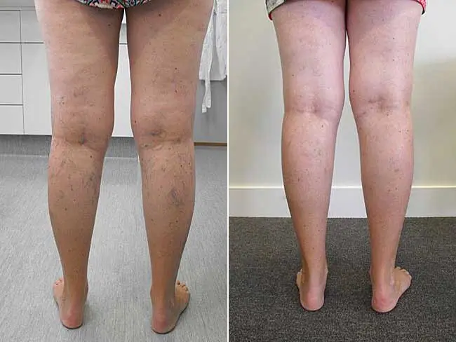 Patient 2 Spider Vein Removal San Antonio Before After Photo