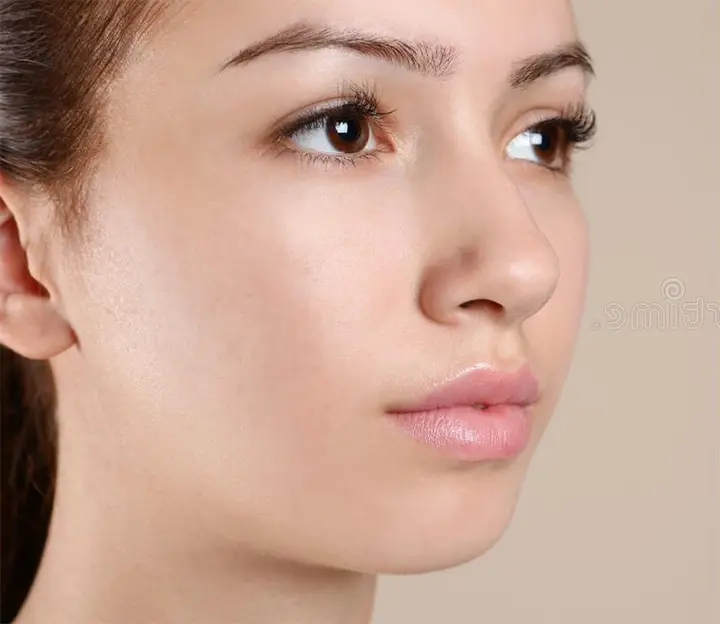 Acne Treatment San Antonio After Photo