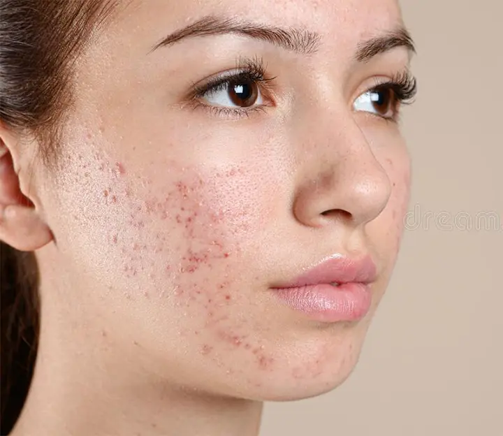 Acne Treatment San Antonio Before Photo