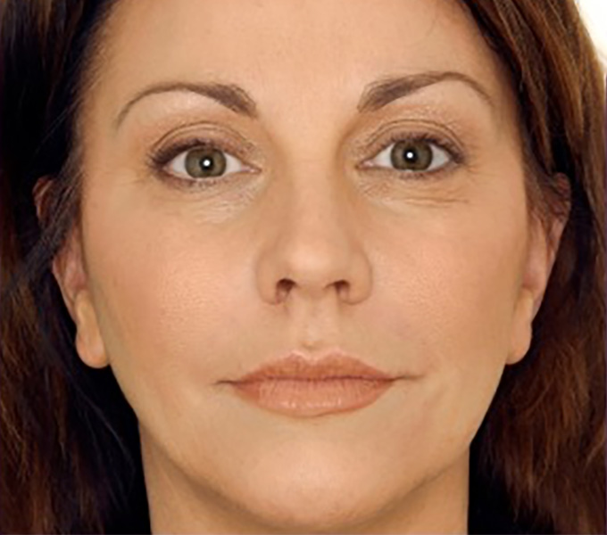 Botox After Photo Patient 3