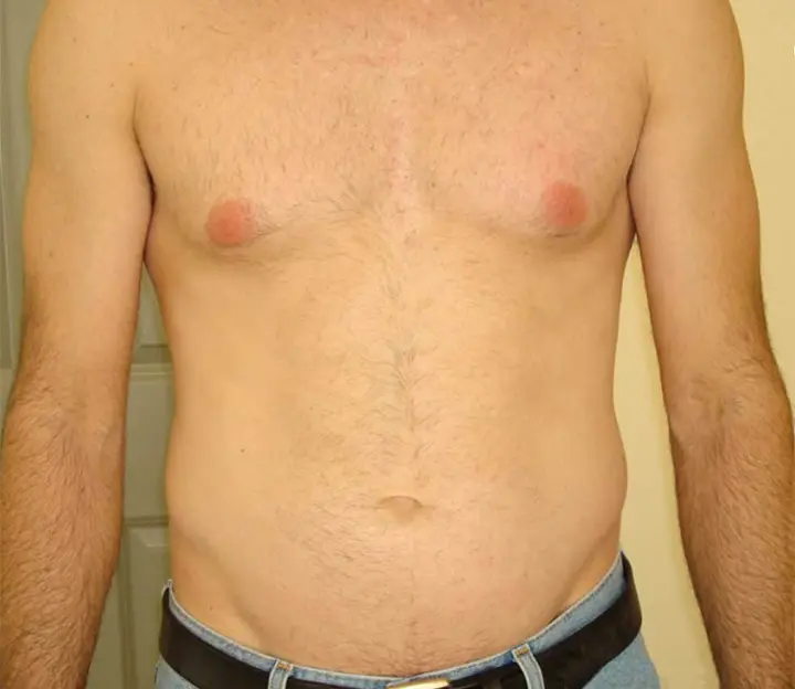 Laser Hair Removal San Antonio After Photo