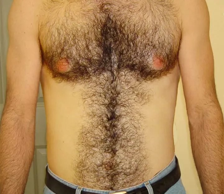 Laser Hair Removal San Antonio Before Photo