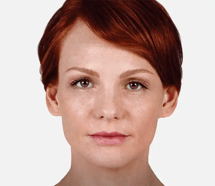 Juvederm Fillers San Antonio After Photos