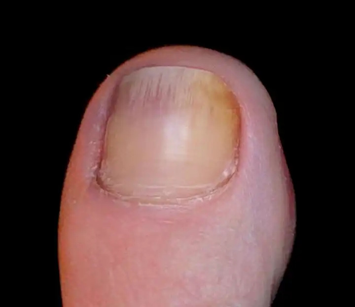 Nail Fungus Removal San Antonio, TX