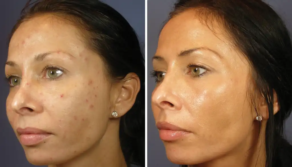 Patient 1 Chemical Peels San Antonio Before & After Photo