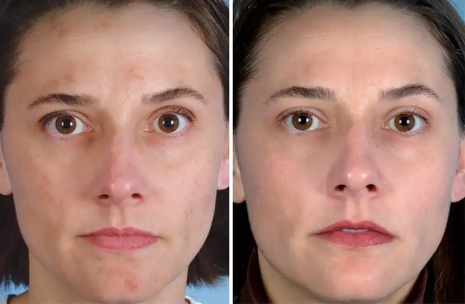 Patient 1 Microdermabrasion Before & After Photos