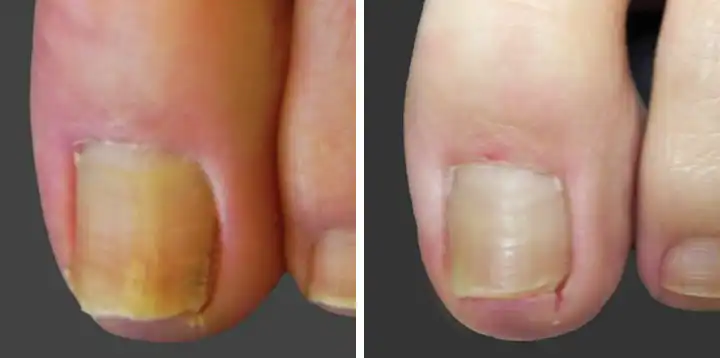 Patient 1 Nail Fungus Removal San Antonio Before After Photo