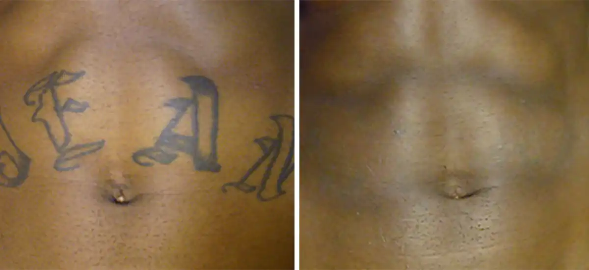 Patient 1 Tattoo Removal San Antonio Before After Photos