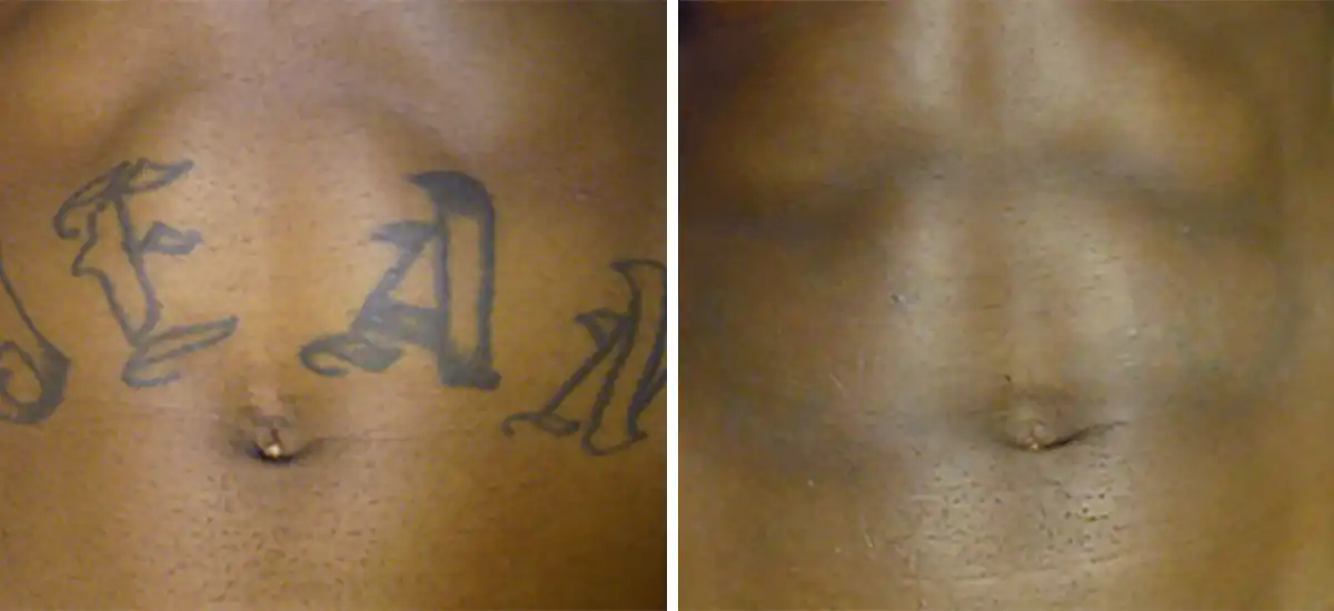 THE BEST 10 Tattoo Removal in San Antonio TX  Last Updated September 2023   Yelp