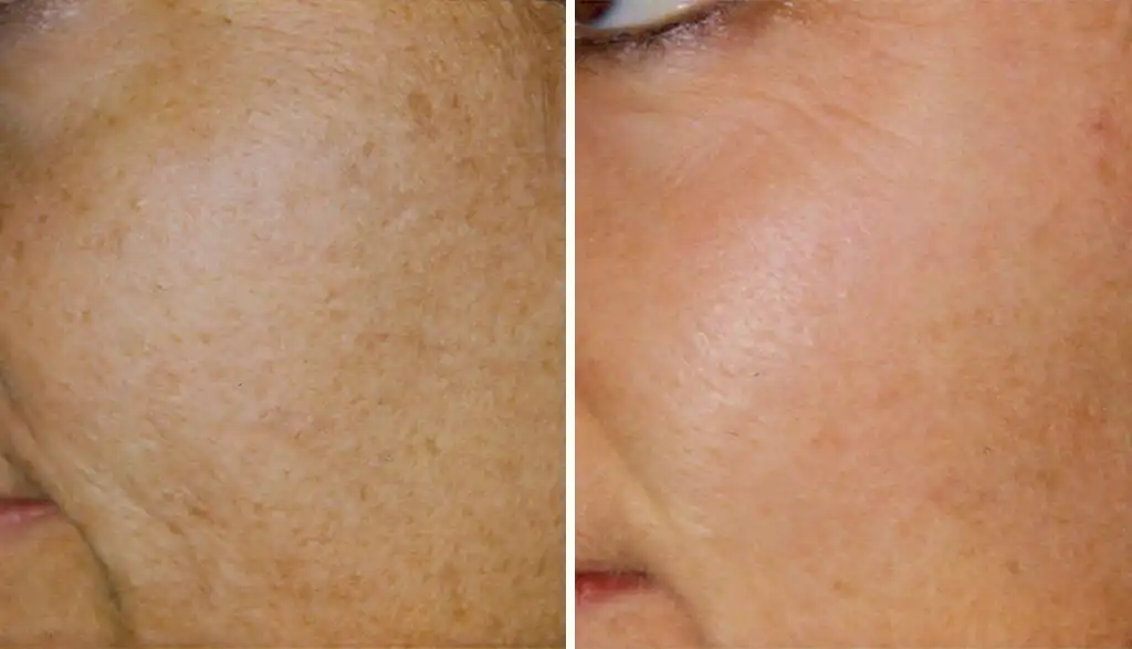 Patient 2 Chemical Peels San Antonio Before & After Photo