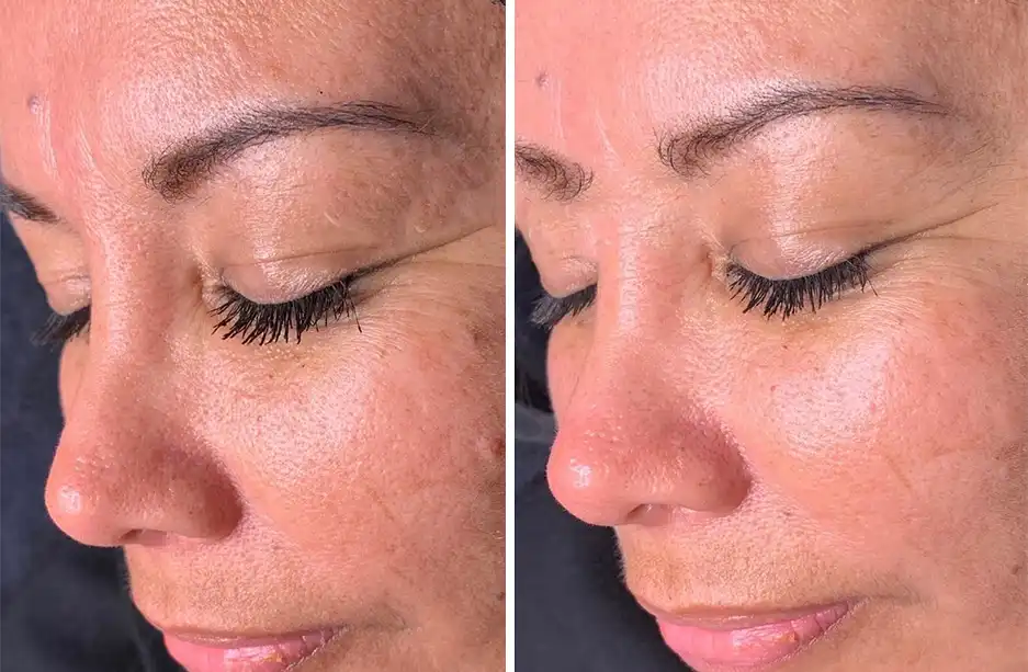 Patient 2 Microdermabrasion San Antonio, TX Before After Photos