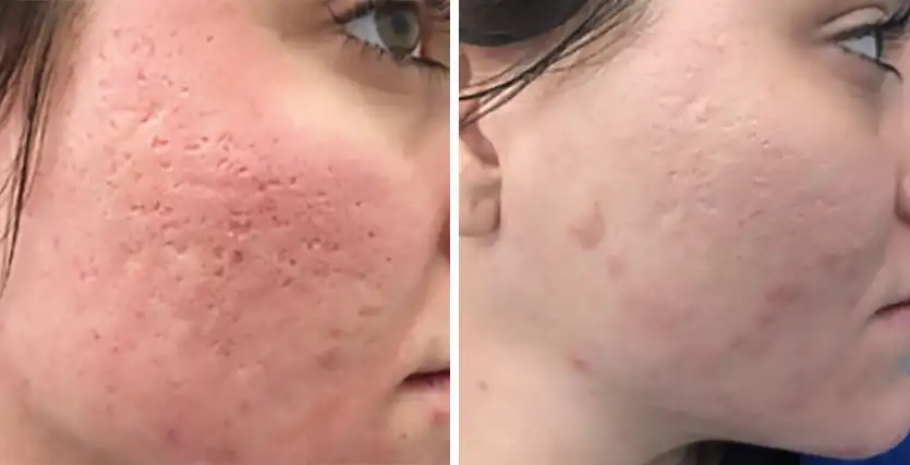 Patient 2 Microneedling Before & After Photos