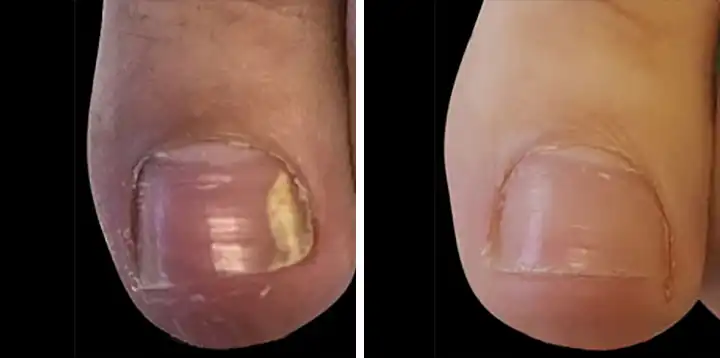 Patient 2 Nail Fungus Removal San Antonio Before After Photo