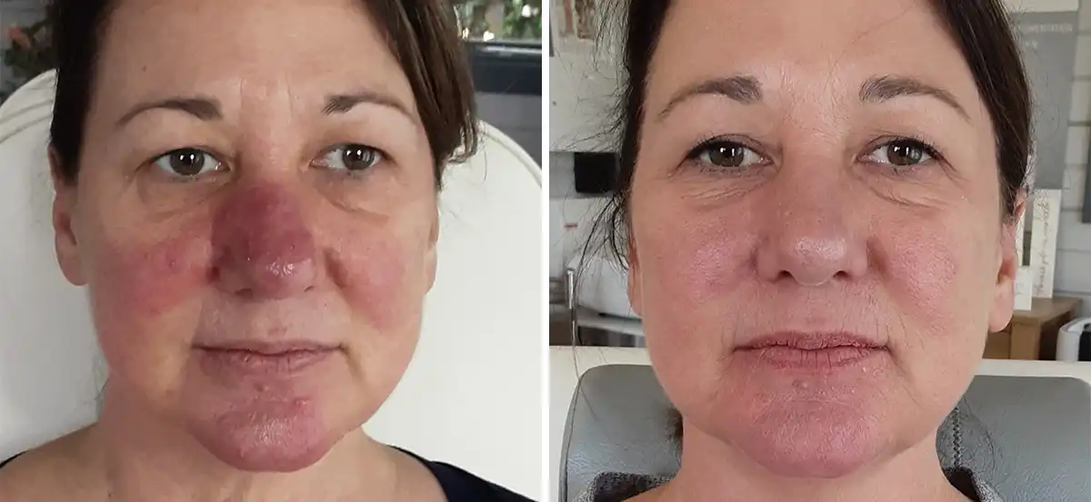 Patient 2 Rosacea Treatment San Antonio Before and After Photo
