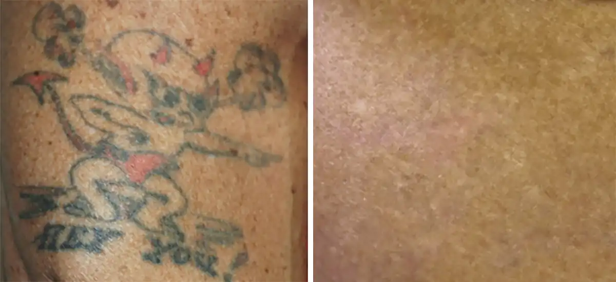 Patient 2 Tattoo Removal San Antonio Before After Photos