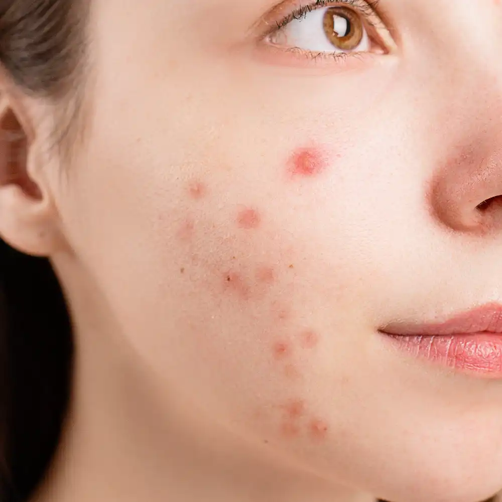 Before After Acne Treatment Photos | Magnolia Medical & Aesthetics