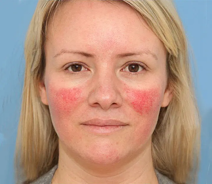 Rosacea Treatment San Antonio | Magnolia Medical & Aesthetics