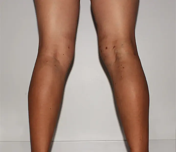 Spider Vein Removal San Antonio After Photo