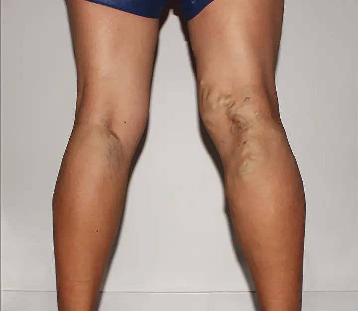 Spider Vein Removal San Antonio Before Photo