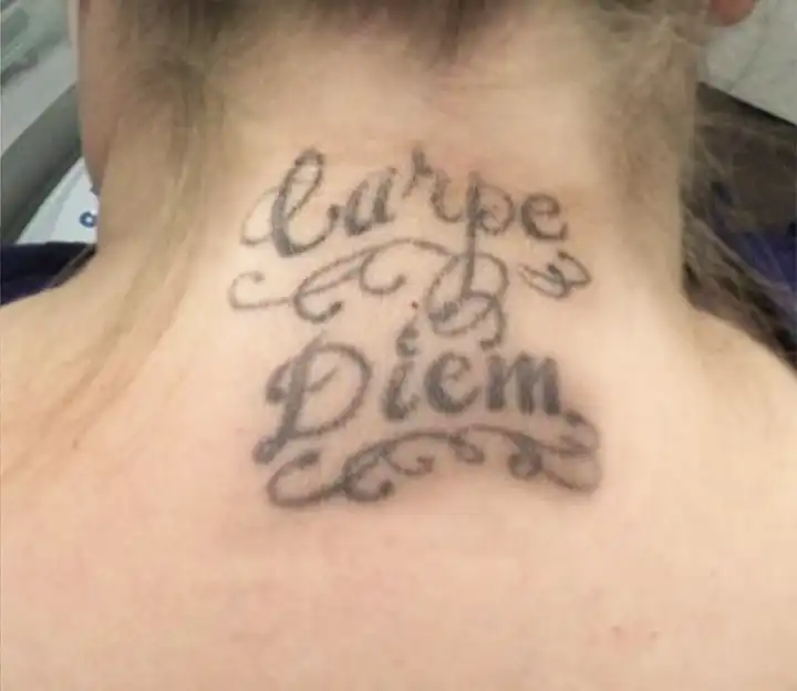 Clean Canvas Laser Tattoo Removal  Houston TX