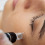 5 Amazing Benefits Of Microneedling