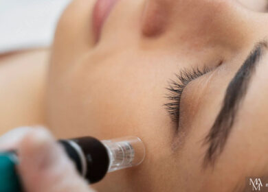 5 Amazing Benefits Of Microneedling