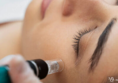 5 Amazing Benefits Of Microneedling