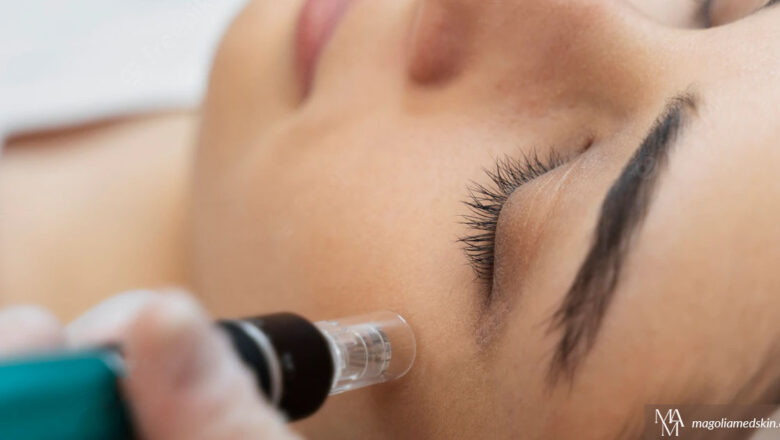5 Amazing Benefits Of Microneedling