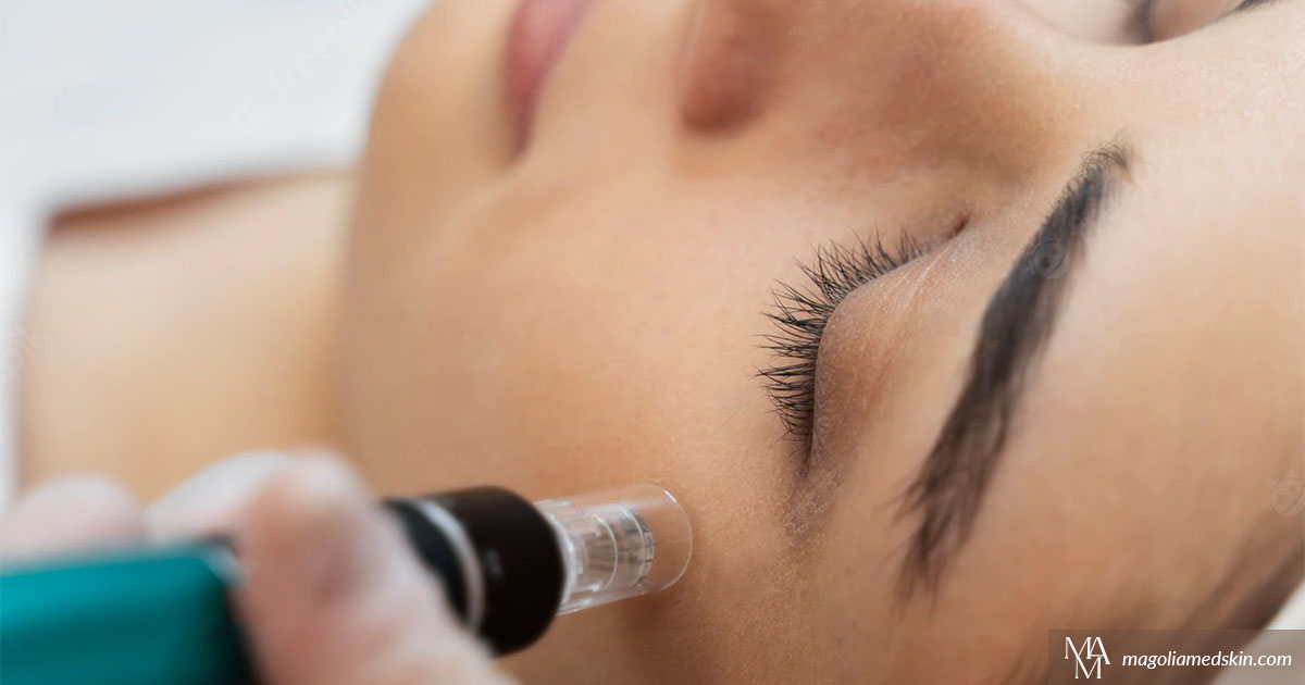 5 Amazing Benefits Of Microneedling