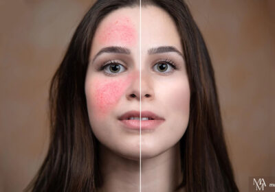 What Is The Best Treatment For Rosacea?