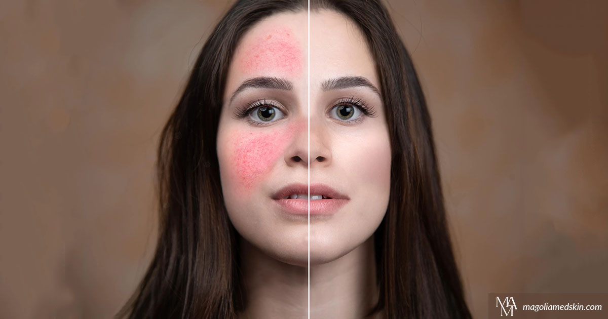What Is The Best Treatment For Rosacea?