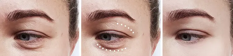 Sagging Skin Signs of Aging Around Eyes