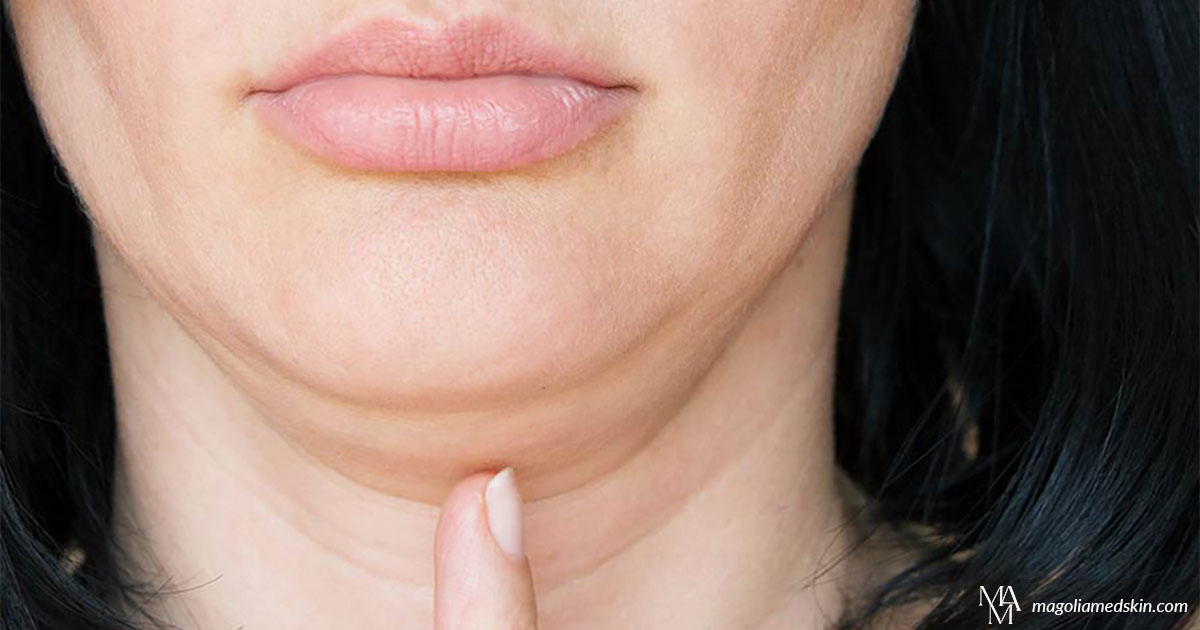 How To Get Rid Of The Dreaded Double Chin