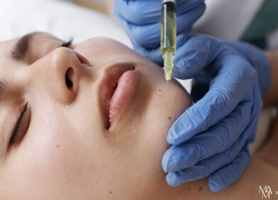 4 Interesting Facts About Dermal Fillers