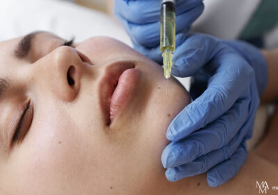 4 Interesting Facts About Dermal Fillers
