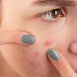 How To Treat Embarrassing Acne