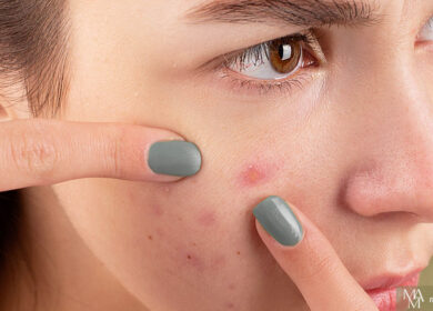 How To Treat Embarrassing Acne