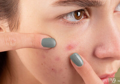 How To Treat Embarrassing Acne