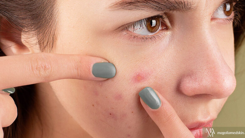 How To Treat Embarrassing Acne