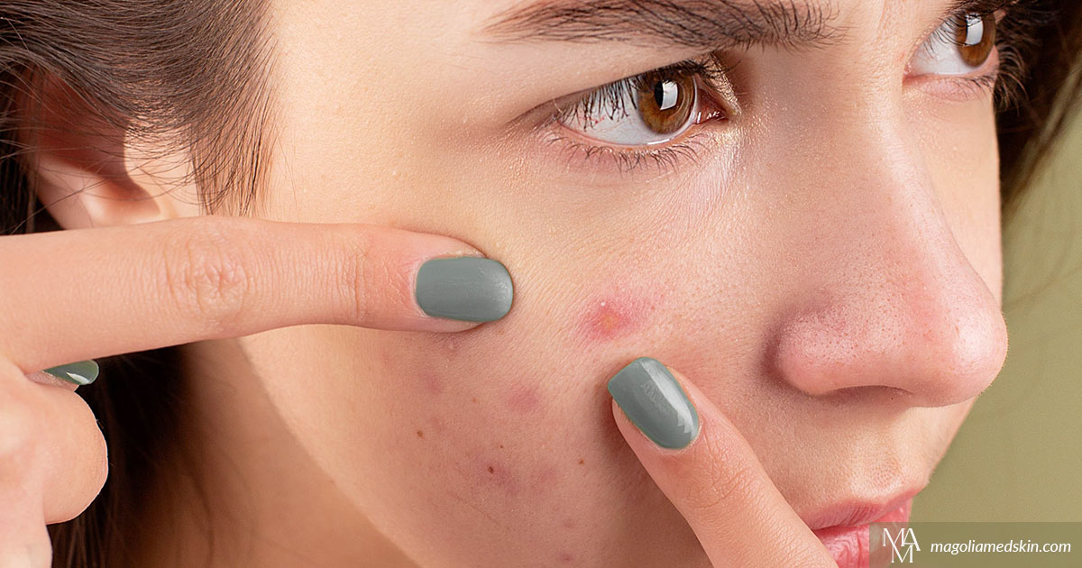 How To Treat Embarrassing Acne