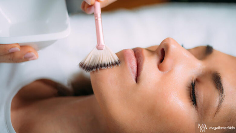 Why Get A Chemical Peel On Your Face