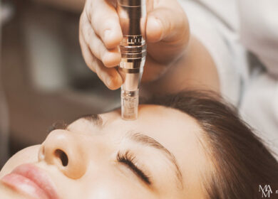 How Often Should I Get Microneedling Treatment?