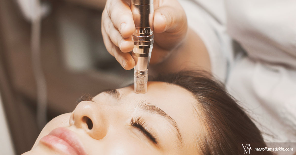 How Often Should I Get Microneedling Treatment?