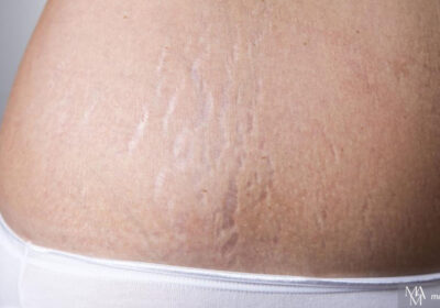 How We Use Microneedling For Stretch Marks