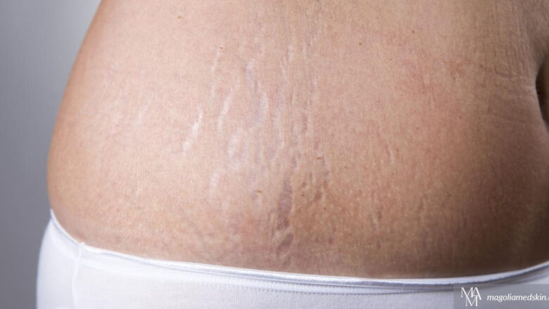How We Use Microneedling For Stretch Marks