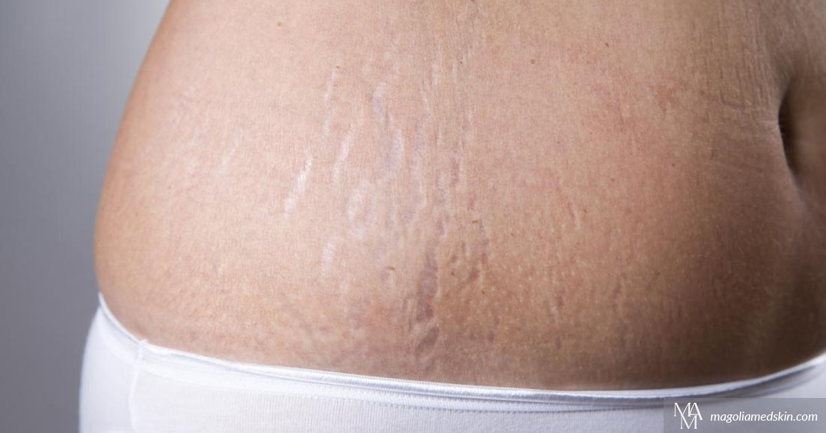 How We Use Microneedling For Stretch Marks