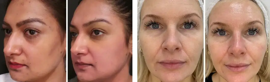 Hydrafacial Before & After Photos | Magnolia Medical & Aesthetics